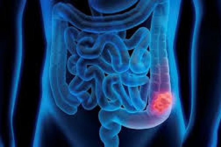 Doktorlara göre tümörleri eriten ilacın bağırsak kanserinde ameliyatın yerini alabilecek