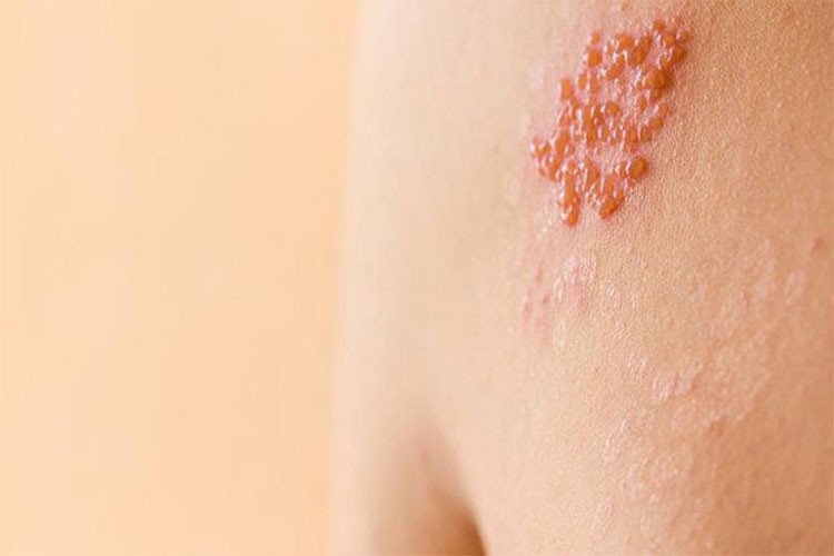 Zona virüsüyle ilgili önemli açıklama