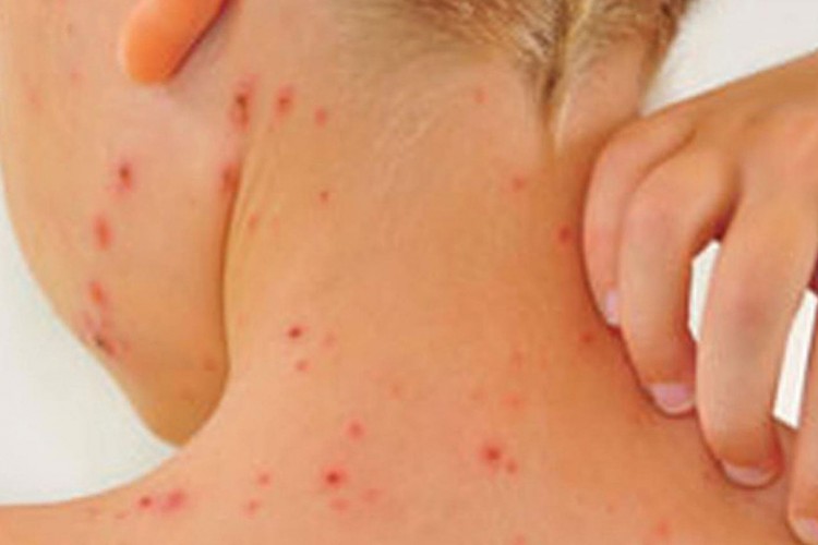 "Kızamık solunum yoluyla bulaşır"