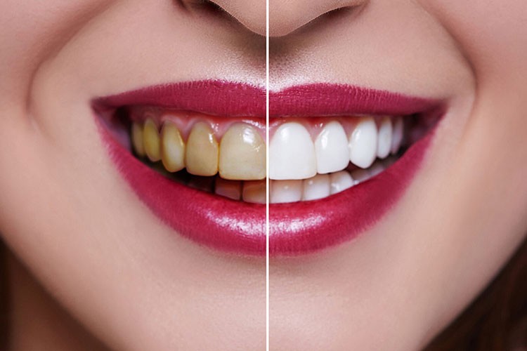 Diş beyazlatmanın herhangi bir zararı yok