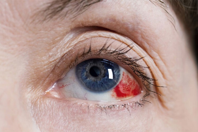 Glokomda Erken Müdahale Görme Yetisini Koruyor