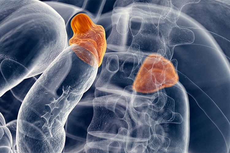 Adrenal kitleler sağlık sorunlarına yol açabiliyor