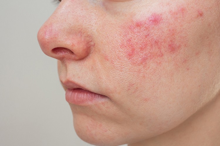 Cildinizdeki kızarıklıklar Rozasea belirtisi olabilir