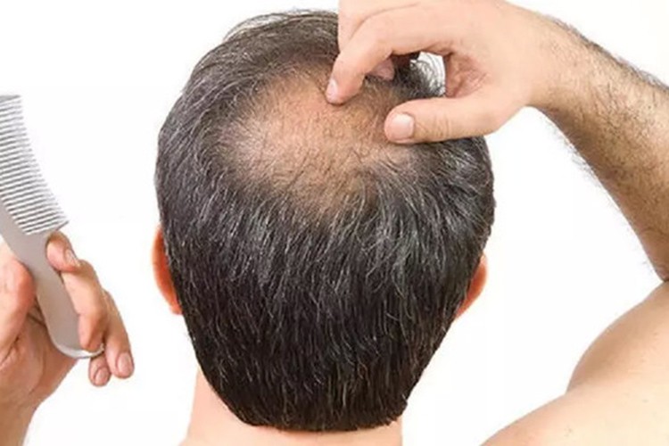 Saç dökülmesinde dökülme tipi tanının konulmasında önemli unsur