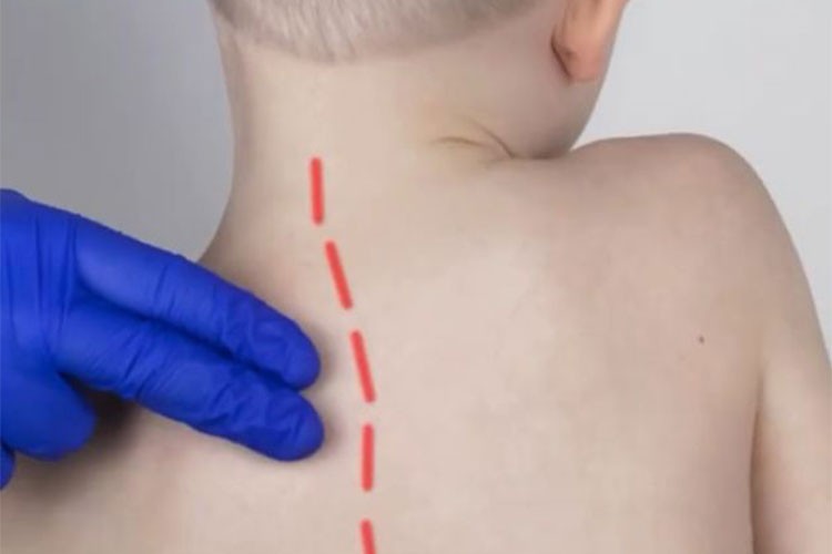 Skolyoz Tedavisinde Erken Tanı ve Tedavi Önemli...