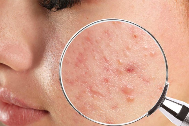 Akne her 5 kadından 1'inde görülüyor