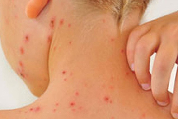 Uzmanından "kızamıktan korunmak için aşı şart" uyarısı