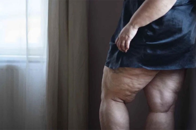 Kadınların Gizli Düşmanı: Lipödem