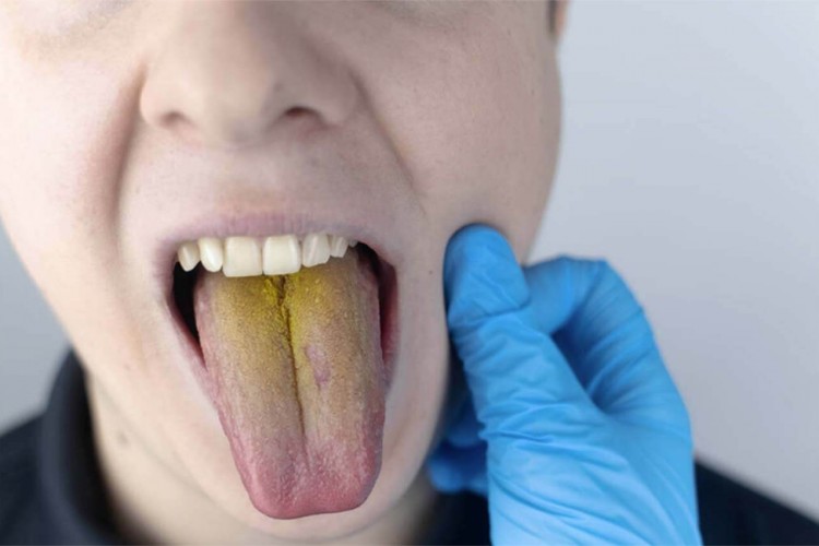 DİLDEKİ RENK DEĞİŞİMİ NE ANLAMA GELİYOR, BİZE NE SÖYLEMEK İSTİYOR?