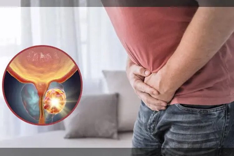 Her 10 erkekten biri prostat kanseri teşhisi alıyor