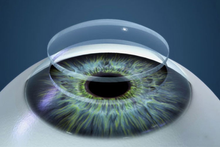 Kornea tedavisine yönelik değerlendirme