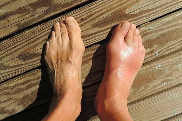 Gut hastalığı eklem sağlığını tehdit ediyor