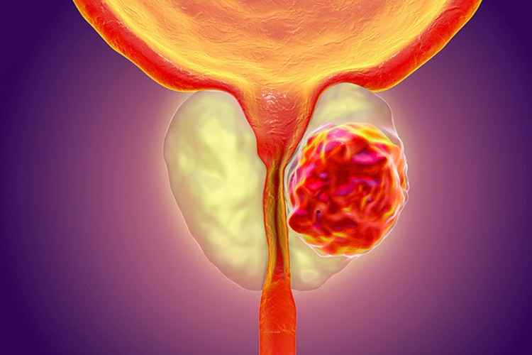 Prostat kanserinde tanı için düzenli kontrol önerisi