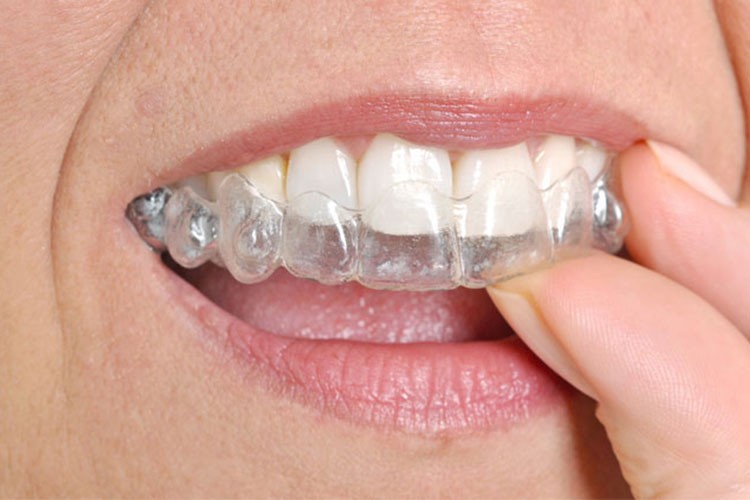 Diş tedavisinde "şeffaf plak" uygulamaları tercih ediliyor