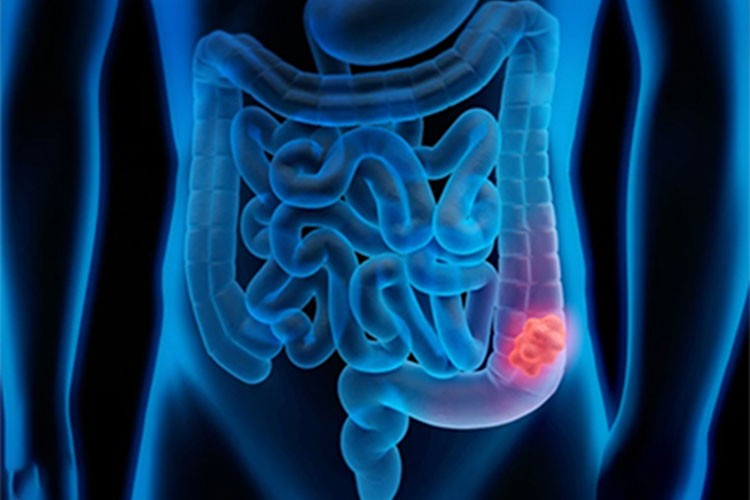 Mide ve bağırsak kanserinde erken teşhisin önemi