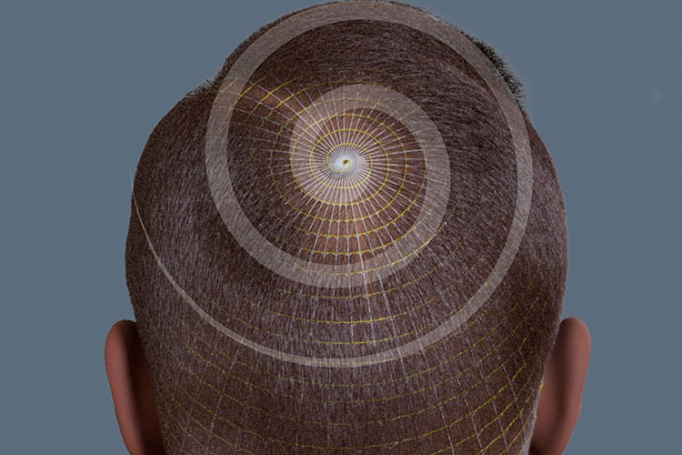 Türk bilim insanlarından yeni saç ekim yöntemi