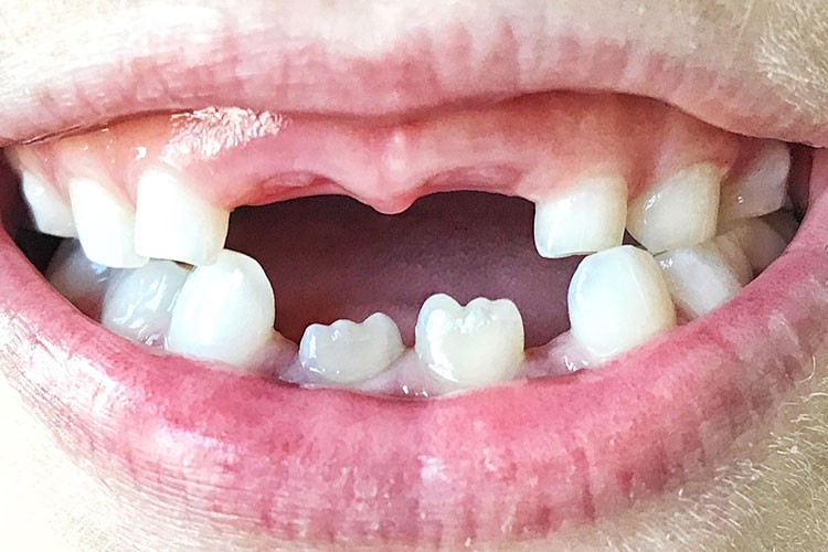 Eksik diş, birçok sağlık fonksiyonunu olumsuz etkiliyor