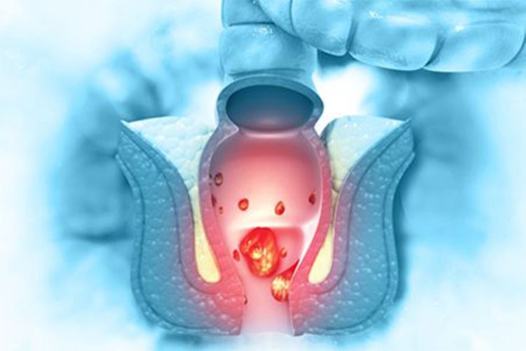 Makat kanamaları kanser riski taşıyabilir
