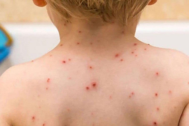 Kızamık Vakalarında Korkutan Artış