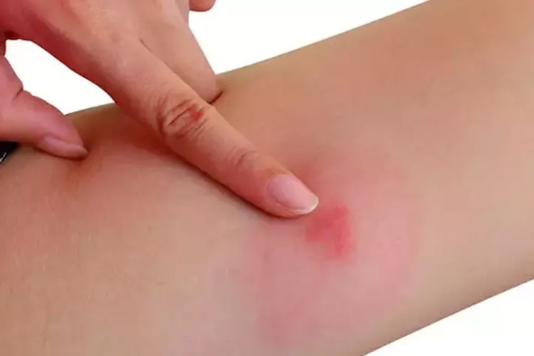 Böcek ısırıklarına karşı korunma yöntemi