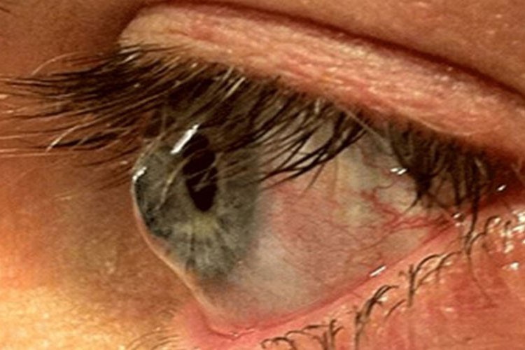 "Bazı durumlarda kaybedilen görmeleri geri kazanabiliyoruz"